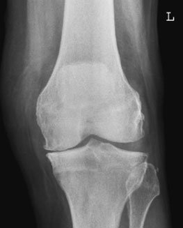 în ortostatism Antero-posterior (AP) Genunchi radiografie evidențiind loss de height de the