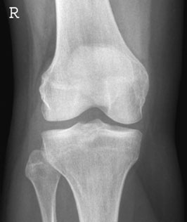 but it poate also fie marker de occult suspiciune de fractură, e.g. tibial coloană vertebrală