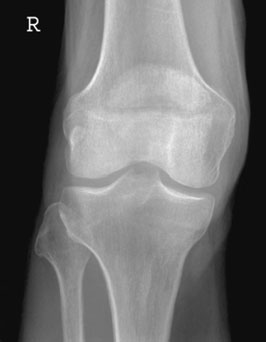 sau platou tibial suspiciune de fractură. Lipohaemarthrosis occurs when a