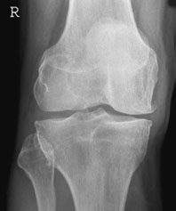 ideal pentru evidențiind discrete Rotulă (Patelă) bony abnormalities.