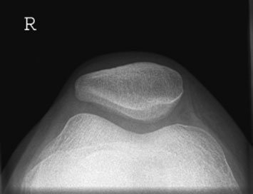 Infero-Superioară (Axială) radiografie cu insufficient flexion causing tibia