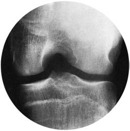 radiografie de intercondylar notch evidențiind loose corp
