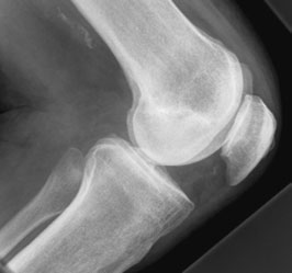 Profil (lateral) radiografie de Genunchi cu