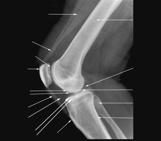Profil (lateral) radiografie de Genunchi cu 45 grade de flexion