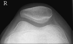 • assess retro-patellar spații articulare pentru degenerative disease;