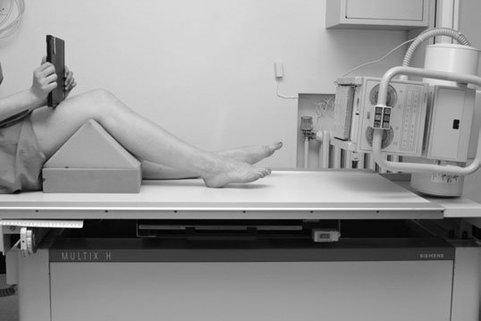 Conventional Infero-Superioară (Axială) incidență evidențiind osteophytosis