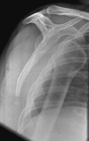 Profil (lateral) Oblică radiografie de Umăr evidențiind anterior luxație articulară