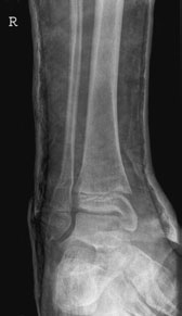 la those pacienți de la suspiciune de fractură clinic cu below-Genunchi plaster