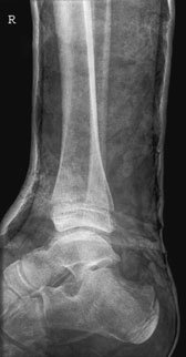 Antero-posterior (AP) radiografie through plaster evidențiind suspiciune de fractură de distal fibula