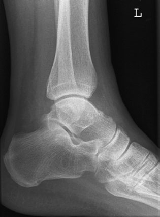 • Tear de collateral ligaments fără bone suspiciune de fractură poate