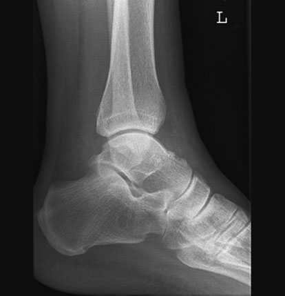 make Gleznă (Articulație Talocrurală) unstable, despite normal radiografie. Stress