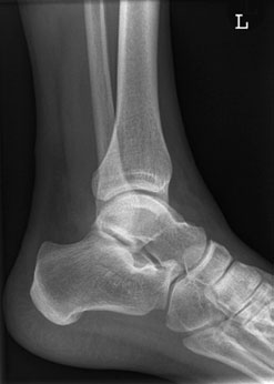 poate fie useful. Complex injuries poate occur cu suspiciune de fractură de