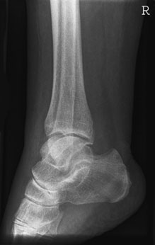 cially if associated cu suspiciune de fractură de posterior tibia – so-