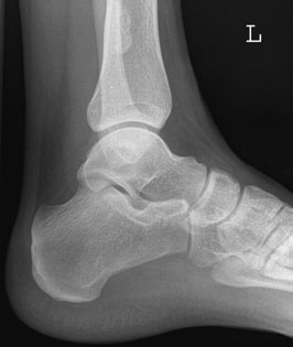 • normal juvenile calcaneal apophysis este dense și often