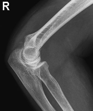 type de injury commonly found în children este suspiciune de fractură de the