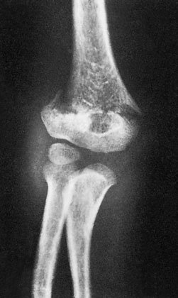 Antero-posterior (AP) radiografie în