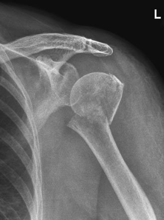 Antero-posterior (AP) radiografie de neck de Humerus taken Ortostatism la show