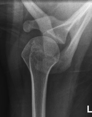 Supero-Inferioară incidență pentru neck de Humerus, evidențiind healing