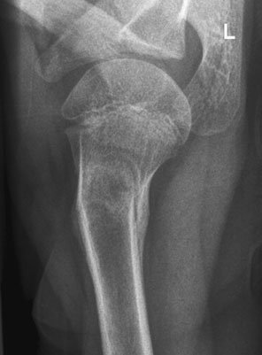 angulated suspiciune de fractură de proximal shaft de Humerus