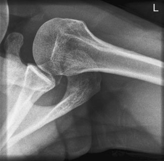 Axială radiografie de Umăr evidențiind posterior luxație articulară
