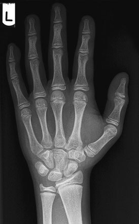 Normal Postero-anterior (PA) radiografie de stâng Mână