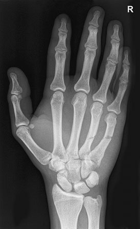 Postero-anterior (PA) radiografie evidențiind suspiciune de fractură de