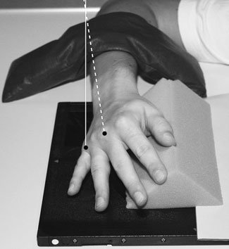 Normal Oblică Anterioară radiografie de stâng Mână