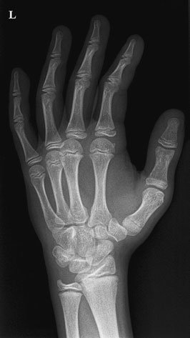 Oblică Anterioară radiografie de drept Mână evidențiind suspiciune de fractură