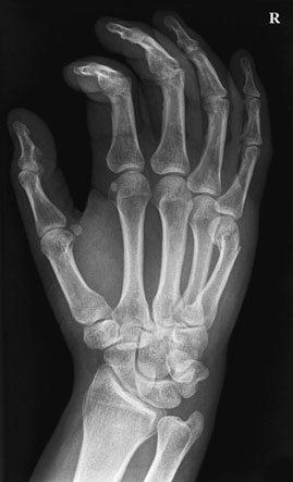 neck de fifth metacarpal (Boxer’s suspiciune de fractură)