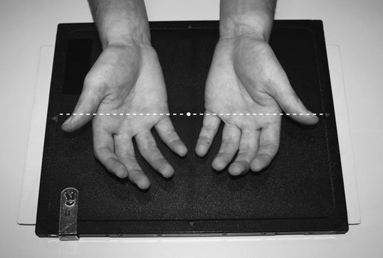 arthritis. It poate also fie used la evidențiază suspiciune de fractură de the