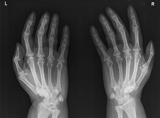 Normal radiografie de mâini în Metoda Incidența Norgaard (Ball-Catcher) (Ball-Catcher) poziție