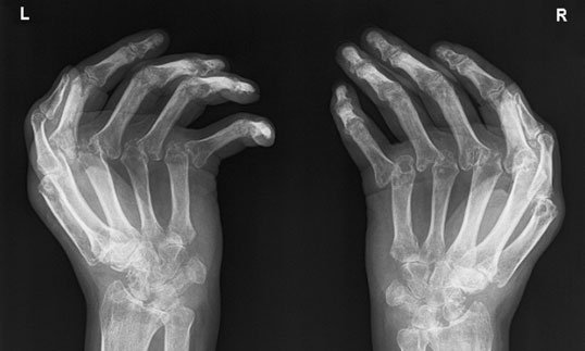 radiografie de mâini în Metoda Incidența Norgaard (Ball-Catcher) (Ball-Catcher) poziție evidențiind severe erosive disease