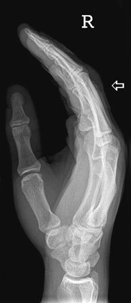 • ‘Boxer’s suspiciune de fractură’ de gâtul de fifth metacarpal este seen