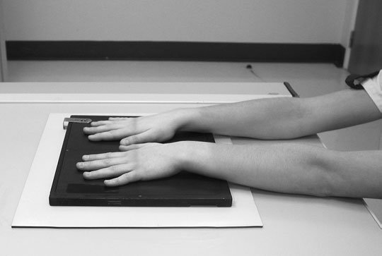 inter-phalangeal articulații de ambele thumbs.