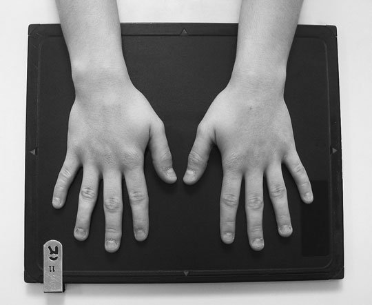 Normal Postero-anterior (PA) radiografie, Ambele Mâini