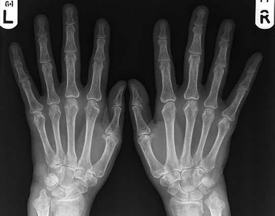 Postero-anterior (PA) radiografie de Ambele Mâini evidențiind severe erosive disease