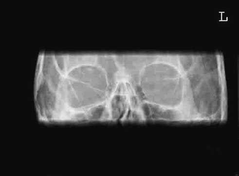 Figura 3: Aspect radiografic / Poziționare (Clark Ed. 12)