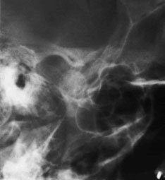 Figura 6: Aspect radiografic / Poziționare (Clark Ed. 12)