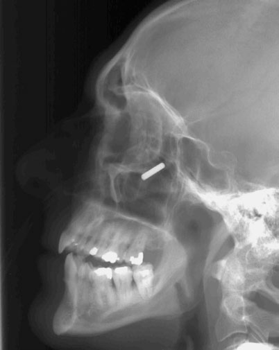 Figura 3: Aspect radiografic / Poziționare (Clark Ed. 12)