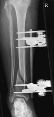 de tracțiune. Pentru membre, se efectuează două radiografii la unghi drept-