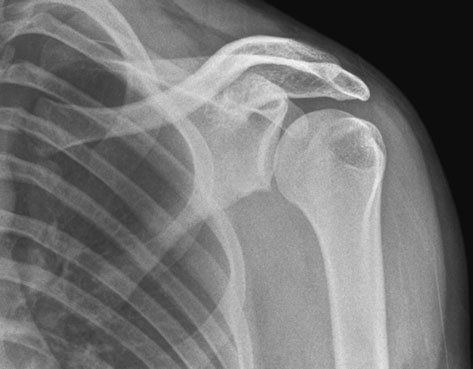 sion suspiciune de fractură de la around glenoid rim este clar evidențiat(e).