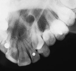 Radiografie dentară ocluzală