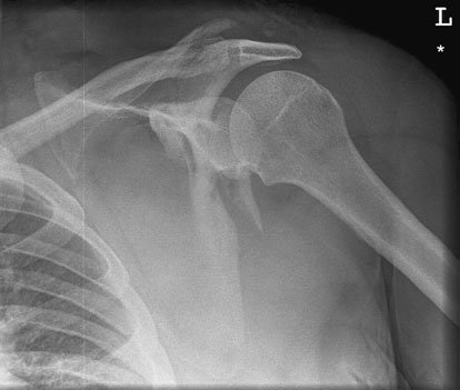Antero-posterior (AP) radiografie de Omoplat (Scapulă) evidențiind suspiciune de fractură through the