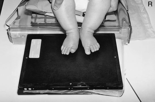 examinare radiografică de picioarele, cu child în ortostatism