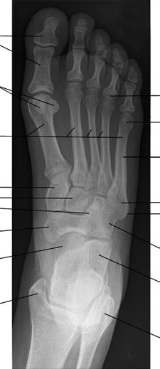 Normal Dorso-Plantară radiografie de Picior