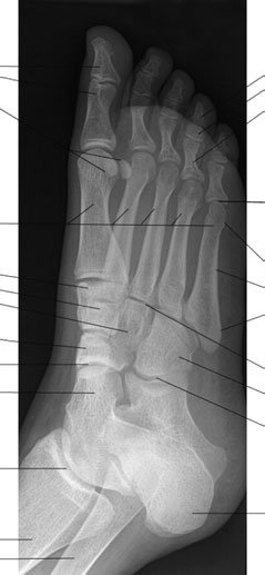 • Lisfranc suspiciune de fractură luxație articulară la bases de oase metatarsiene