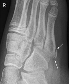 Normal Dorso-Plantară