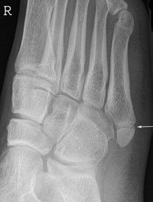Oblică radiografie de Picior