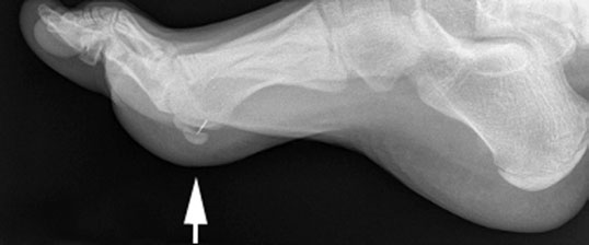 Normal Profil (lateral) radiografie de Picior