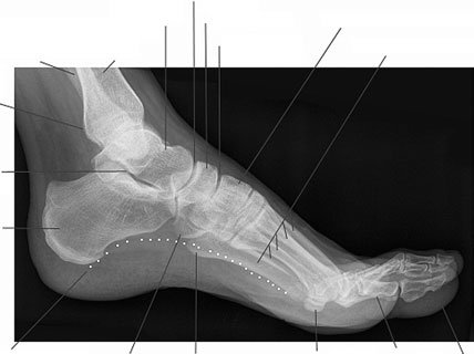 Profil (lateral) radiografie de Picior evidențiind metallic corp străin radiopac